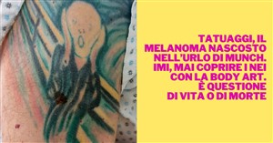 MELANOMA TATUAGGIO