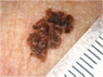 img melanoma01