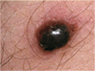 img melanoma02