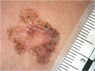 img melanoma03