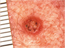 img melanoma04